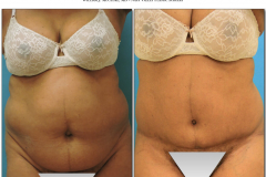 Abdominoplasty-1