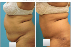 Abdominoplasty-2