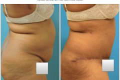 Abdominoplasty-3