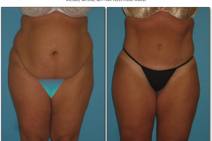 Abdominoplasty.002