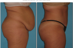Abdominoplasty.003