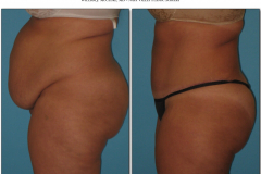 Abdominoplasty.004