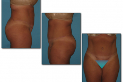 Abdominoplasty.005