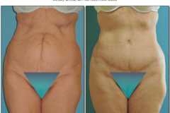 Abdominoplasty.006