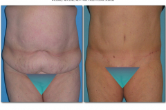 Abdominoplasty.008