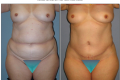 Abdominoplasty.010