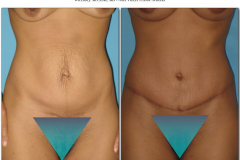 Abdominoplasty.013