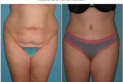 Abdominoplasty.014