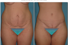 Abdominoplasty.015
