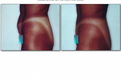 Abdominoplasty.017