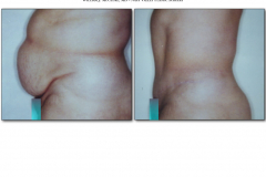 Abdominoplasty.018