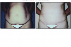 Abdominoplasty.019