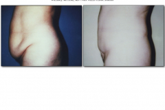 Abdominoplasty.020