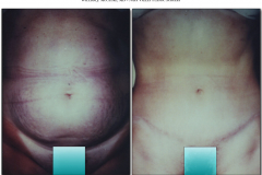 Abdominoplasty.021