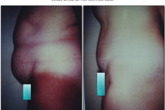 Abdominoplasty.022