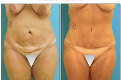 abdominoplasty-4