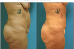 abdominoplasty-5