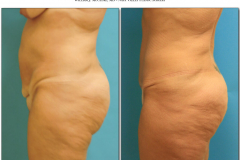 abdominoplasty-6
