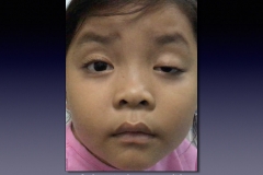 Before-After.004
