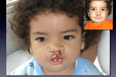 Before-After.047