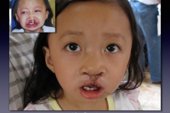 Before-After.051