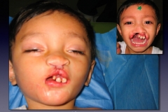 Before-After.053