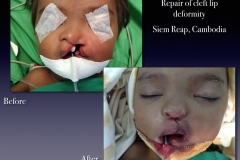 Before-After.063
