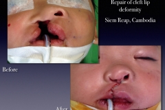 Before-After.065
