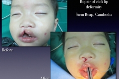 Before-After.070