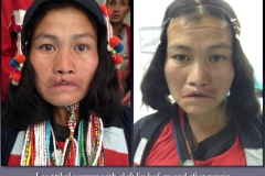Before-After.084