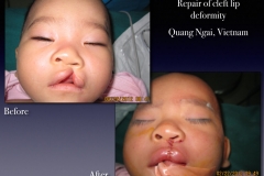 Before-After.092