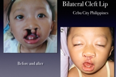 Before-After.095