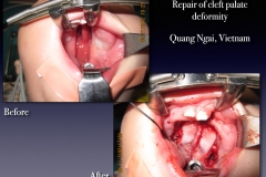 Before-After.122