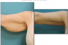 Brachioplasty.013