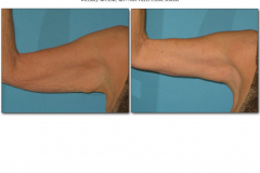 Brachioplasty.016