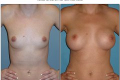 Dr. McClure - Breast Augmentation