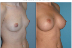 Breast-augmentation.003