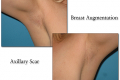 Breast-augmentation.004