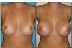 Breast-augmentation.005