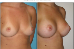 Breast-augmentation.006