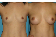 Breast-augmentation.007
