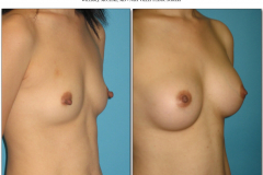 Breast-augmentation.008