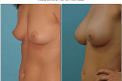 Breast-augmentation.010