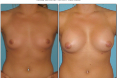 Breast-augmentation.011