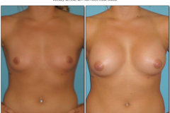 Breast-augmentation.011