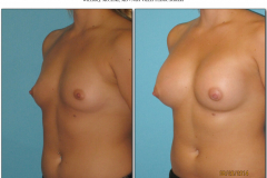 Breast-augmentation.012