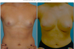 Breast-augmentation.013