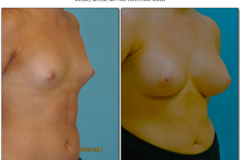 Breast-augmentation.014