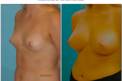 Breast-augmentation.015