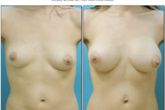 Breast-augmentation.016
